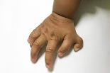 Polydactyly 